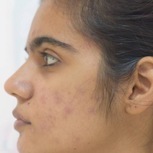 acne-treatment-before-after-dermadent-udaipur-04