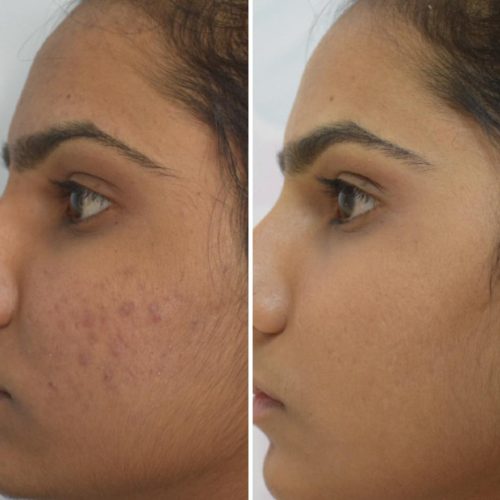 acne-treatment-before-after-dermadent-udaipur-05