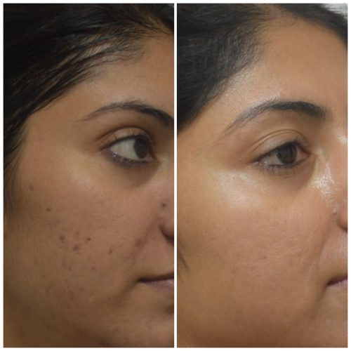acne-treatment-before-after-dermadent-udaipur-06