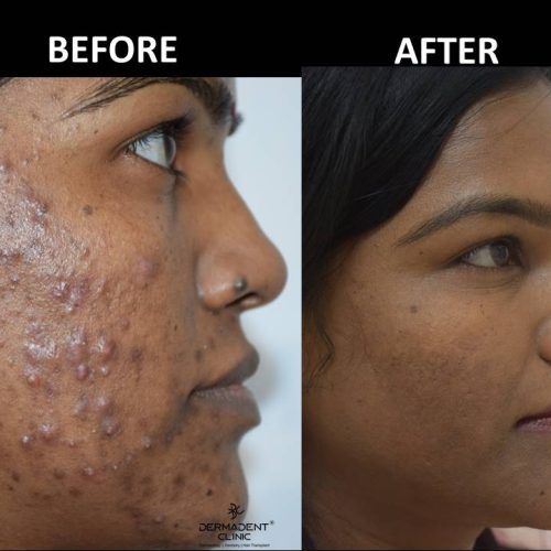 acne-treatment-before-after-dermadent-udaipur-07