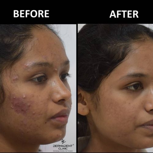 acne-treatment-before-after-dermadent-udaipur-08