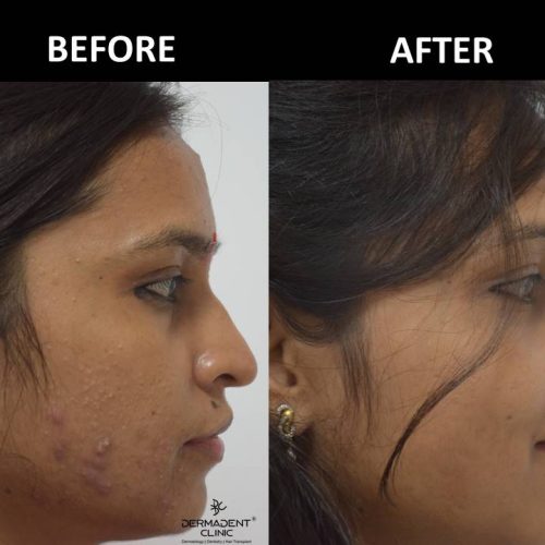 acne-treatment-before-after-dermadent-udaipur-09