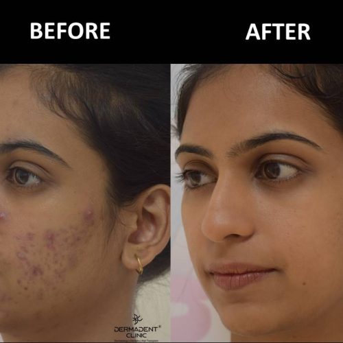 acne-treatment-before-after-dermadent-udaipur-10