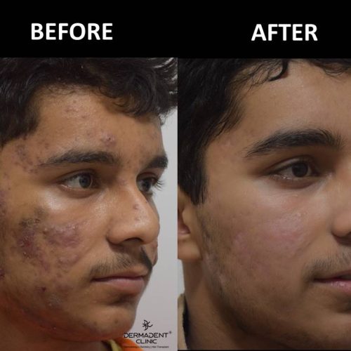 acne-treatment-before-after-dermadent-udaipur-11