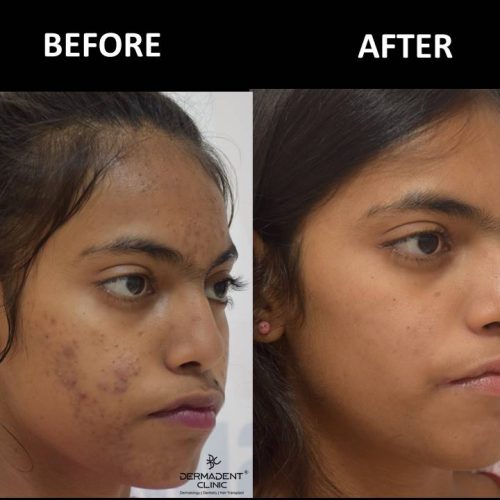 acne-treatment-before-after-dermadent-udaipur-12