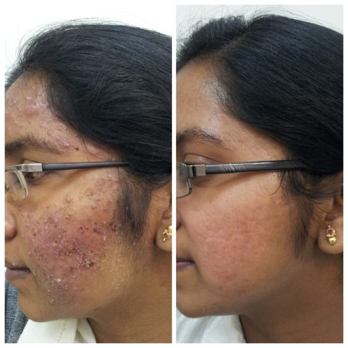 acne-treatment-before-after-dermadent-udaipur-13