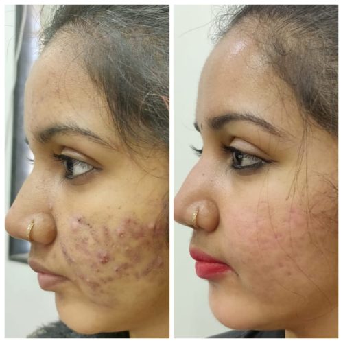 acne-treatment-before-after-dermadent-udaipur-14