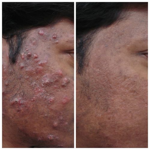 acne-treatment-before-after-dermadent-udaipur-15