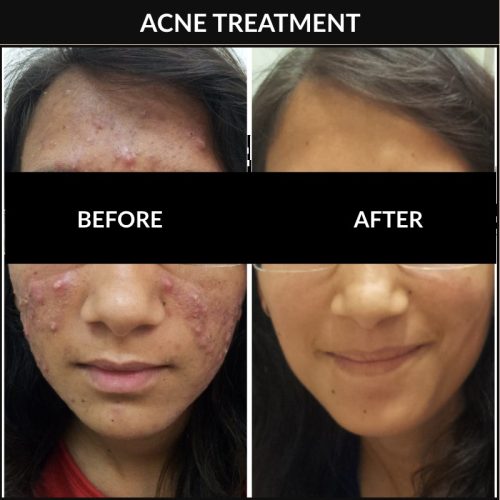acne-treatment-before-after-dermadent-udaipur-16