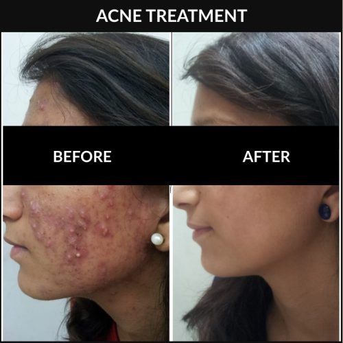 acne-treatment-before-after-dermadent-udaipur-17