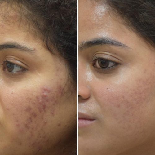 acne-treatment-before-after-dermadent-udaipur-18