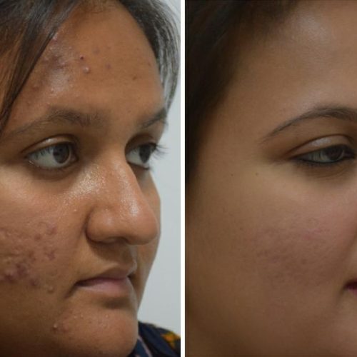 acne-treatment-before-after-dermadent-udaipur-19