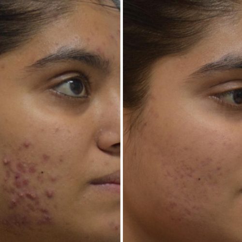 acne-treatment-before-after-dermadent-udaipur-20