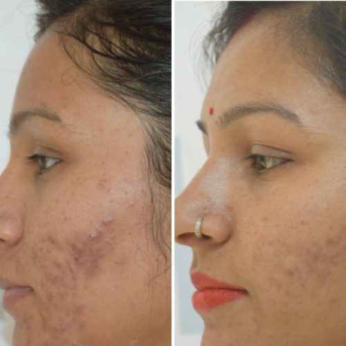 acne-treatment-before-after-dermadent-udaipur-21