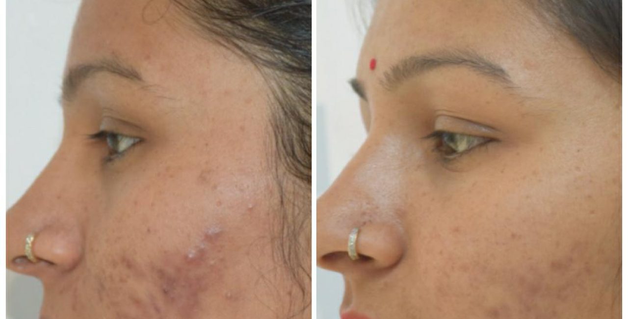 acne-treatment-before-after-dermadent-udaipur-21