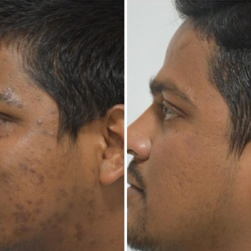 acne-treatment-before-after-dermadent-udaipur-22