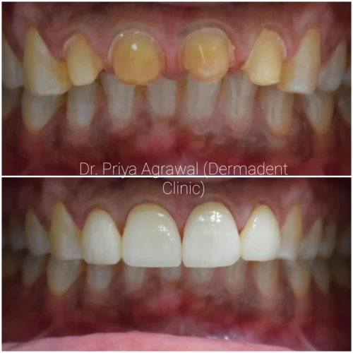 dermadent-udaipur-dental-all-ceramic-crowns