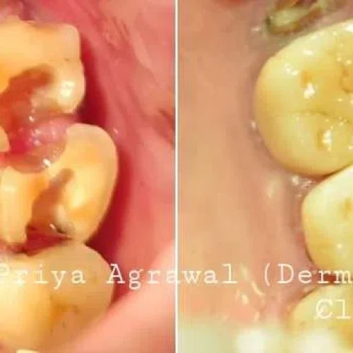 dermadent-udaipur-dental-endo-crown-2