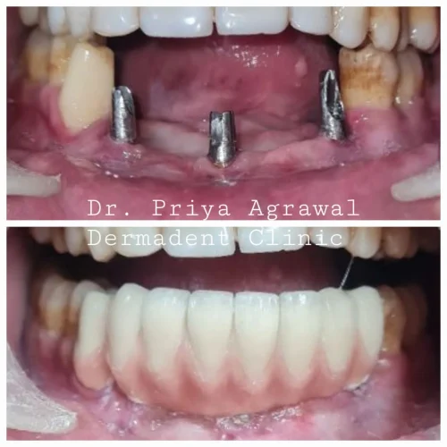 dermadent-udaipur-dental-implant-bridge