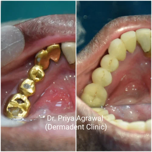 dermadent-udaipur-dental-layered-zirconia-crowns