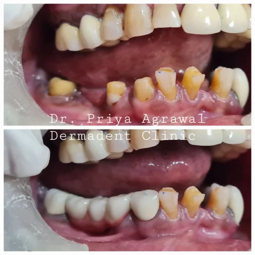dermadent-udaipur-dental-tooth-supported-bridge