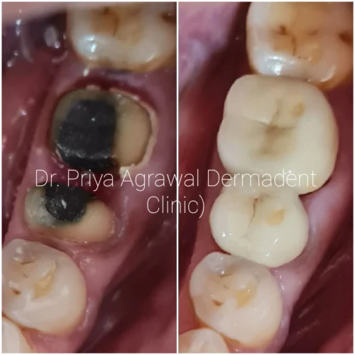 dermadent-udaipur-dental-zirconia-crowns