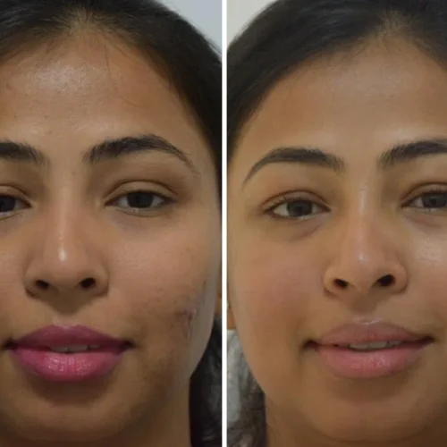 dermadent-udaipur-skin-laser-toning-brighting-2