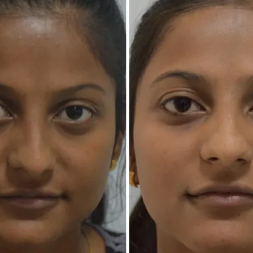 dermadent-udaipur-skin-laser-toning-brighting-3
