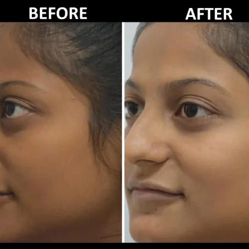 dermadent-udaipur-skin-laser-toning-slide1