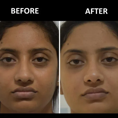 dermadent-udaipur-skin-laser-toning-slide10