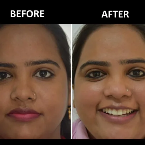 dermadent-udaipur-skin-laser-toning-slide11