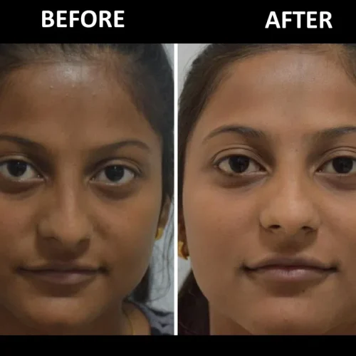 dermadent-udaipur-skin-laser-toning-slide2