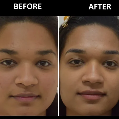 dermadent-udaipur-skin-laser-toning-slide3