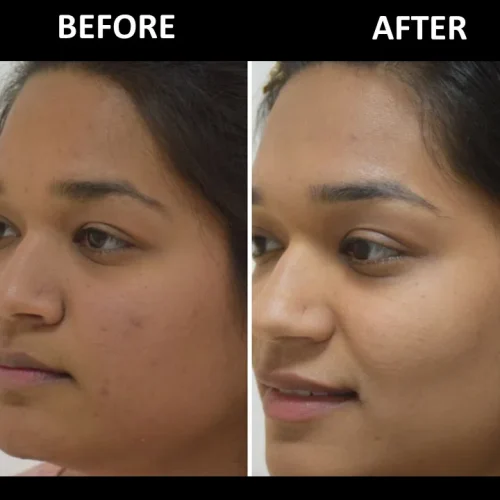 dermadent-udaipur-skin-laser-toning-slide4