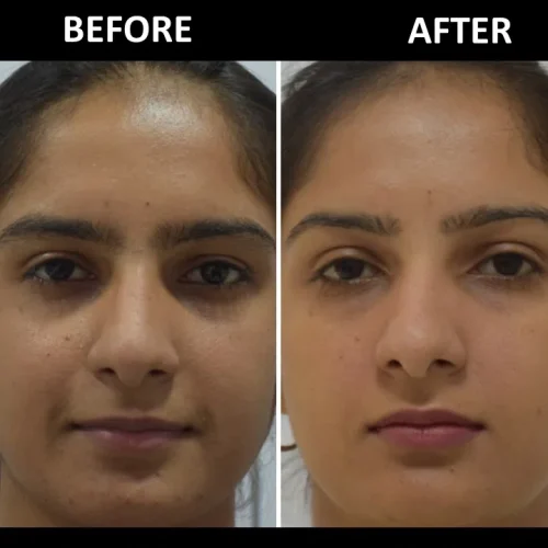 dermadent-udaipur-skin-laser-toning-slide5