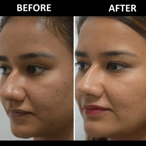dermadent-udaipur-skin-laser-toning-slide6