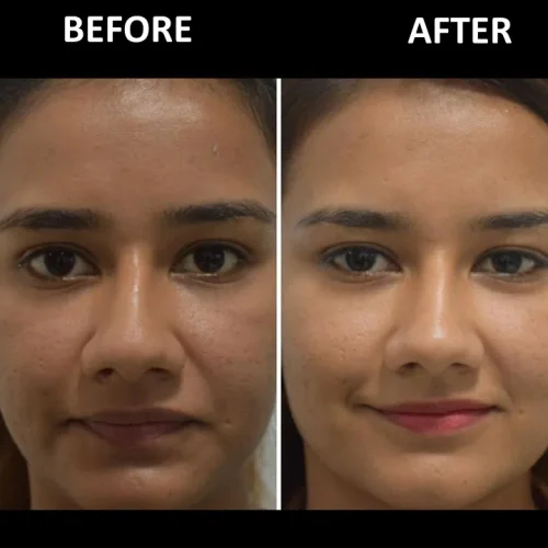dermadent-udaipur-skin-laser-toning-slide7