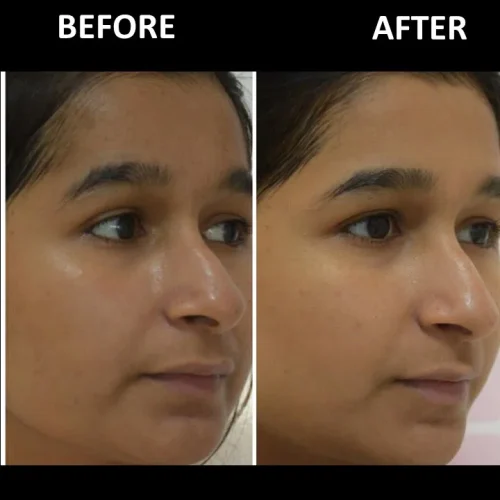 dermadent-udaipur-skin-laser-toning-slide8