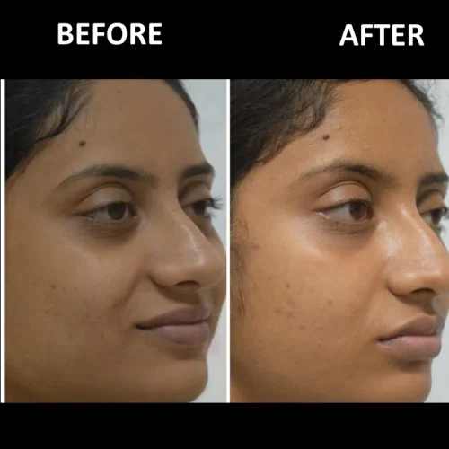 dermadent-udaipur-skin-laser-toning-slide9